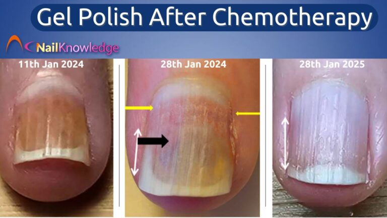 How to Identify Nail Psoriasis Symptoms in Clients